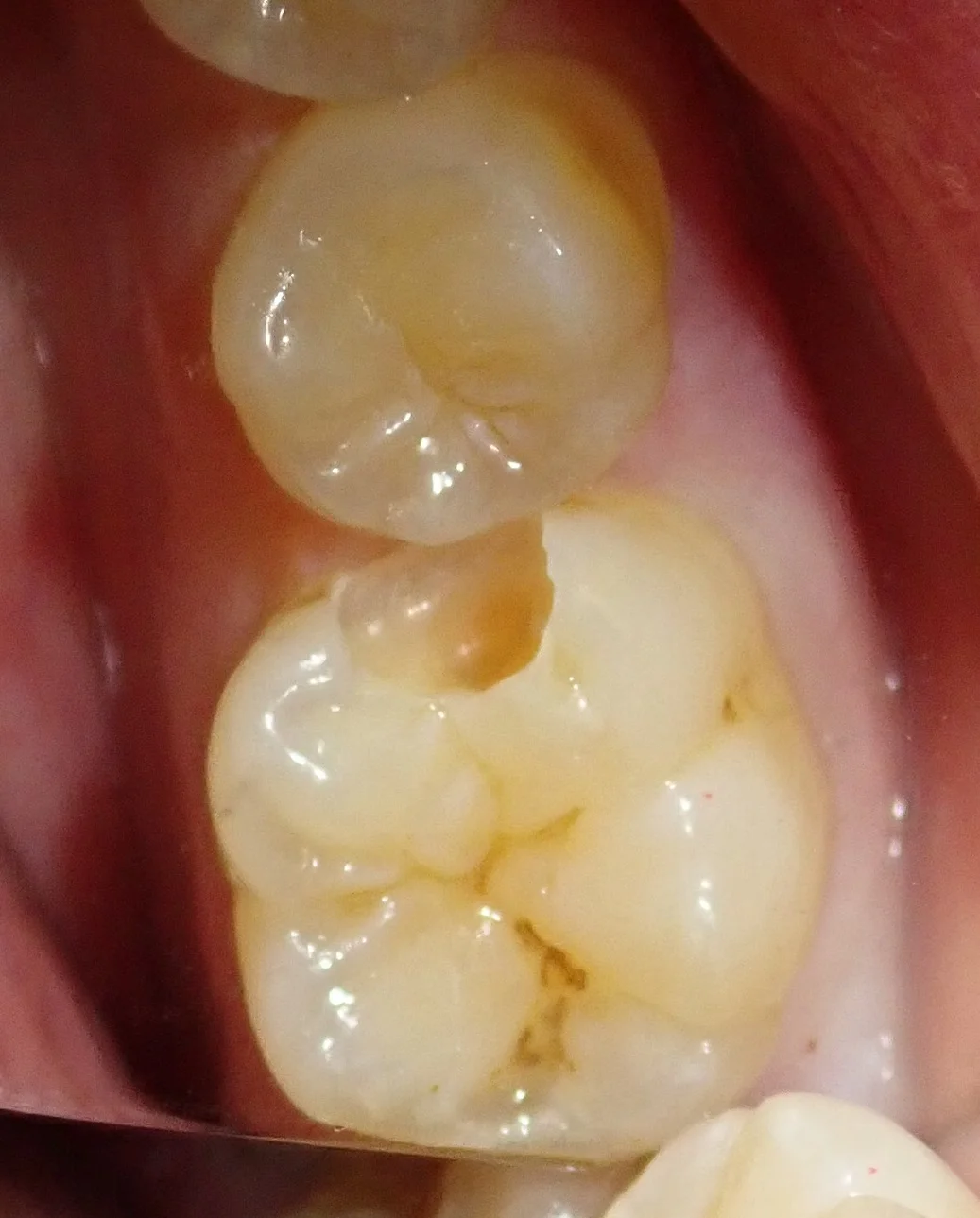 虫歯はない・・・?本当に・・・?|坂寄歯科医院(取手市藤代) - 画像3