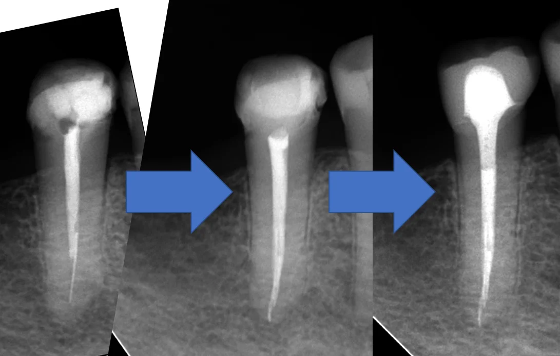 レジンでは無理ですって！｜坂寄歯科医院（取手市藤代） - 画像4