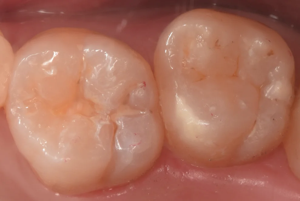 新しくできた虫歯と古い詰め物を同時に治療。｜坂寄歯科医院（取手市藤代） - 画像4