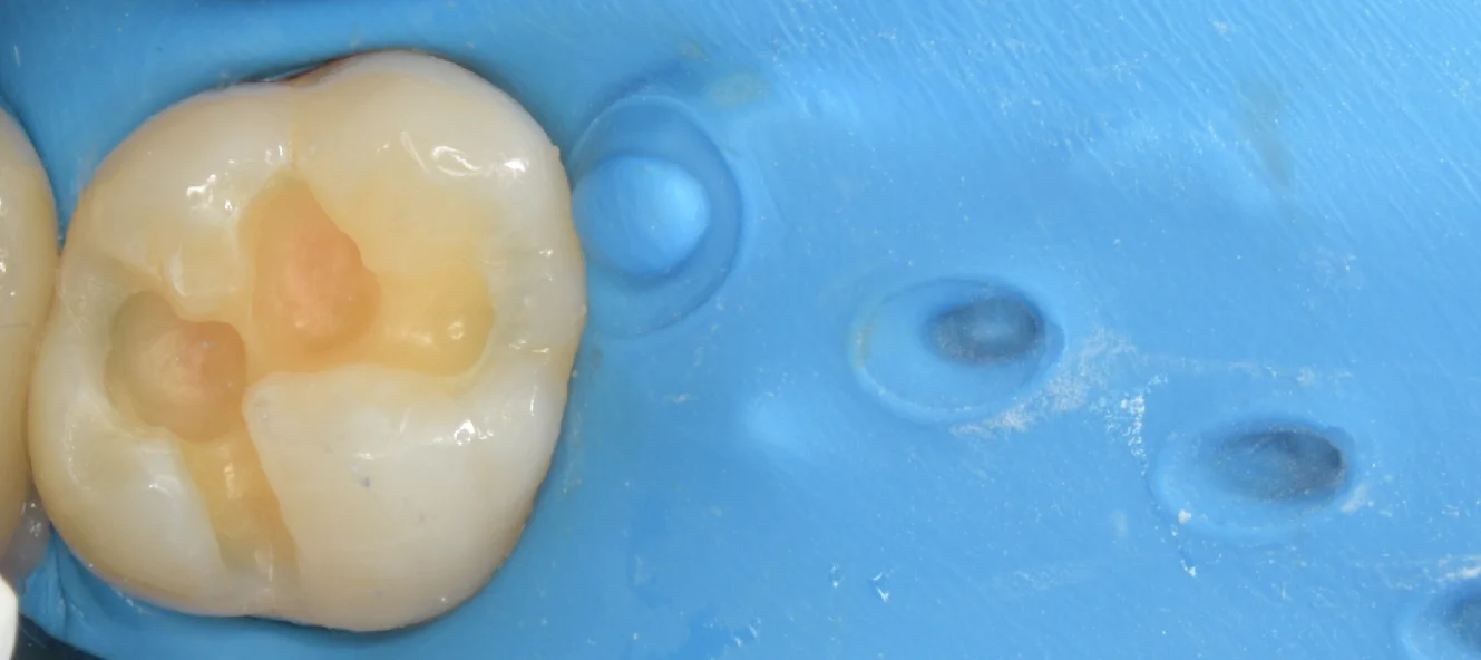 自費の白い詰め物。|坂寄歯科医院(取手市藤代) - 画像3