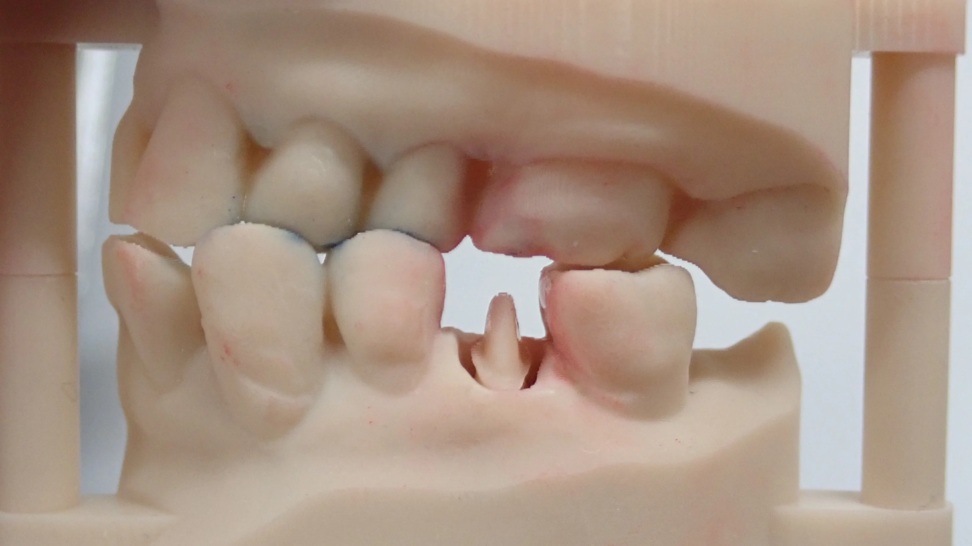 口腔内スキャナーでのセラミック｜坂寄歯科医院（取手市藤代）