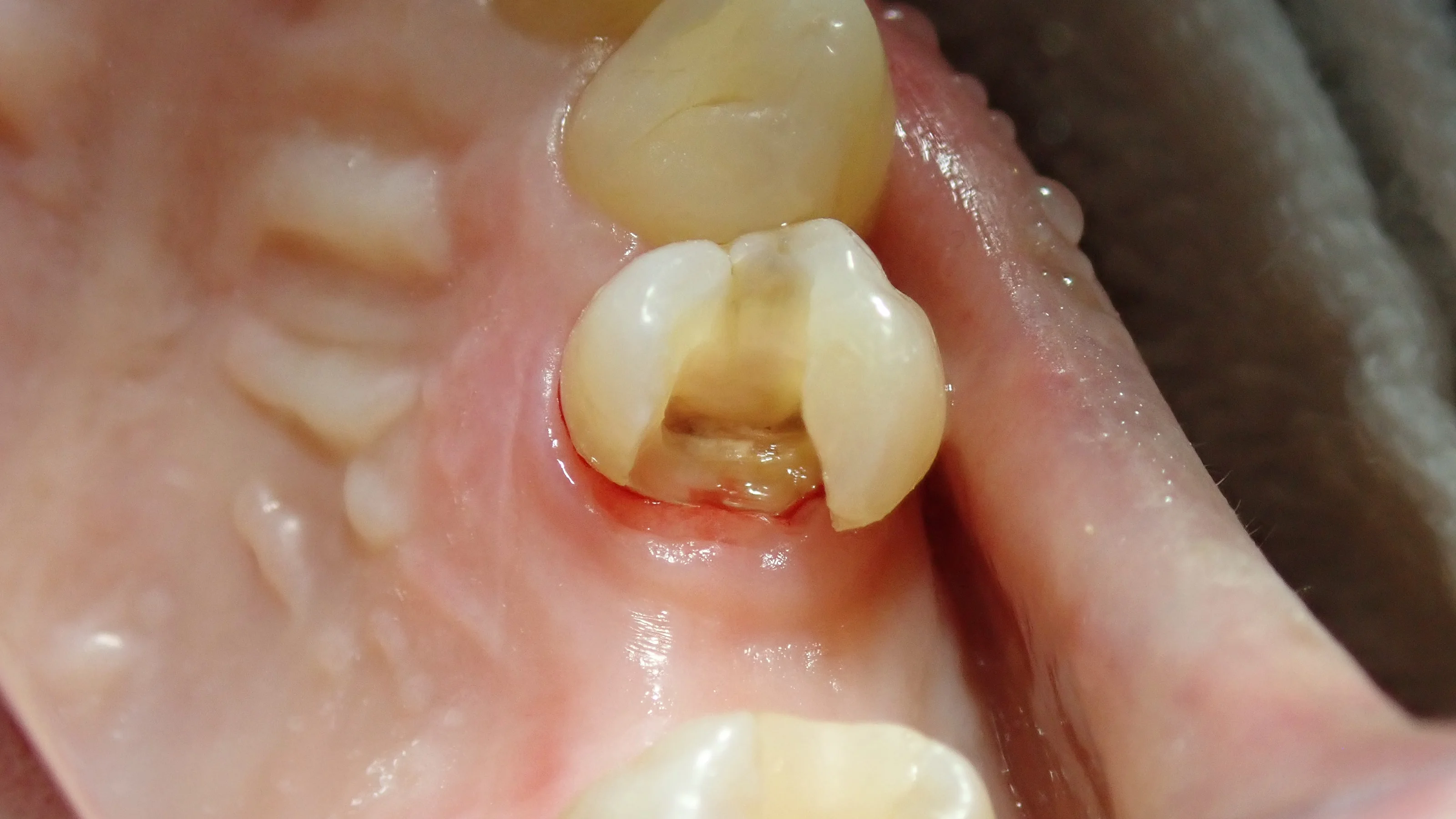 ダイレクトボンディング④|坂寄歯科医院(取手市藤代) - 画像3