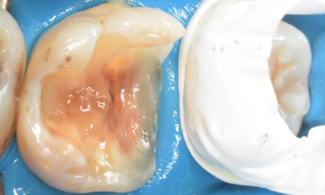 歯科医師の方を治療。｜坂寄歯科医院（取手市藤代） - 画像4