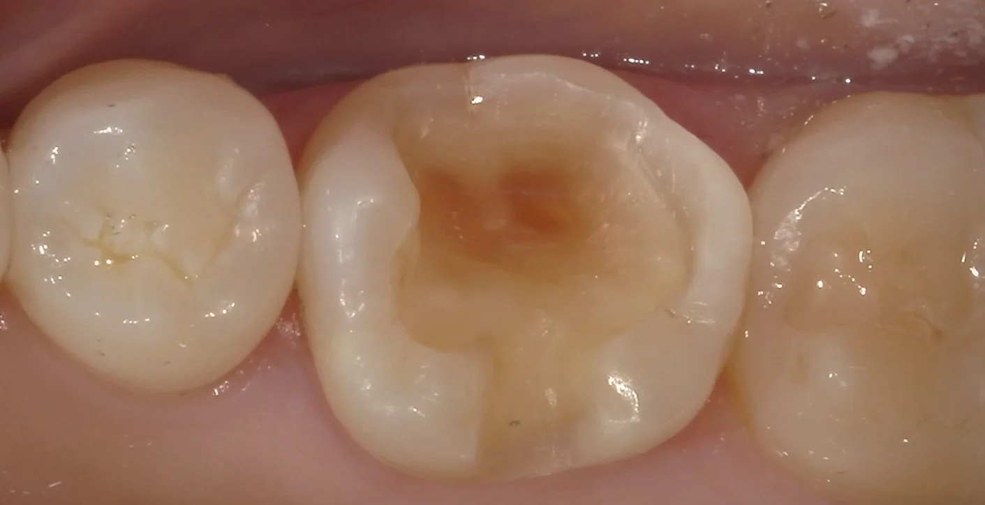 他院勤務中の歯科衛生士さんの治療を行いました。|坂寄歯科医院(取手市藤代) - 画像2