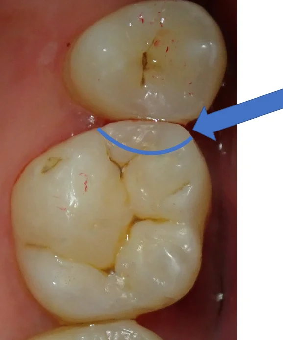 ダイレクトボンディング⑨|坂寄歯科医院(取手市藤代) - 画像3