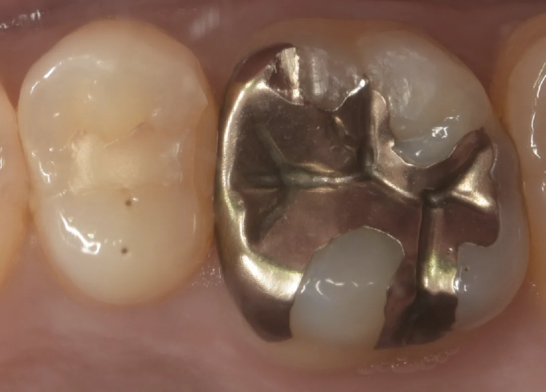 金属の詰め物を白い詰め物に。｜坂寄歯科医院（取手市藤代）