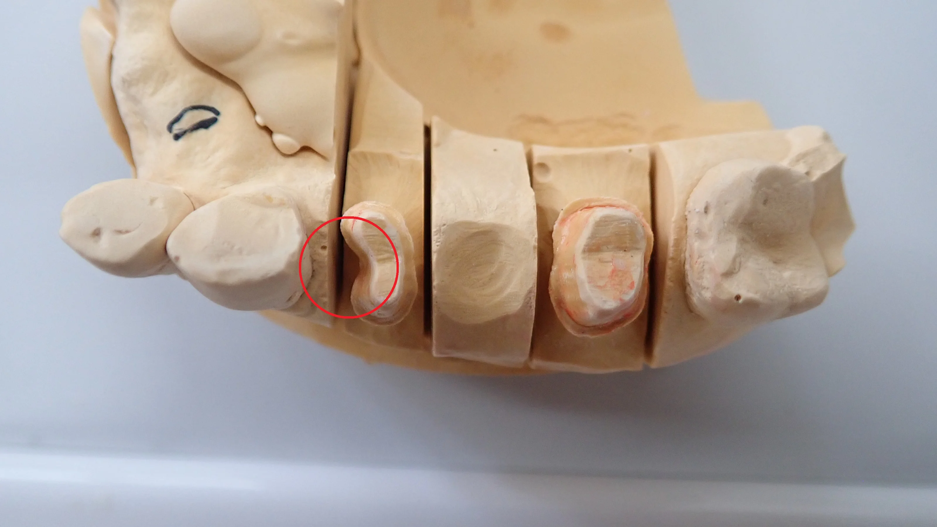 仮歯へのこだわり|坂寄歯科医院(取手市藤代)