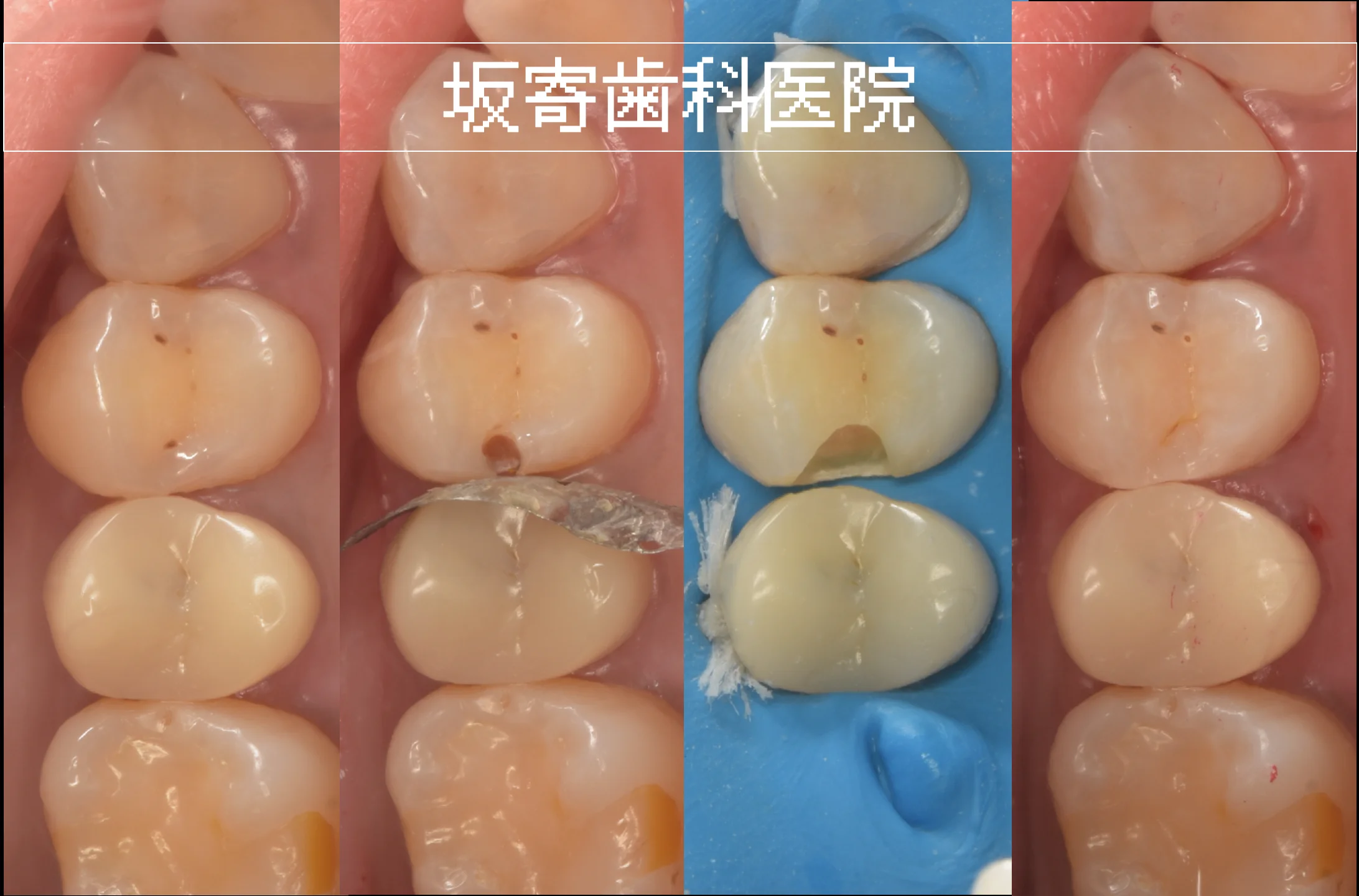 歯をできるだけ残すむし歯治療｜ダイレクトボンディング症例（上顎小臼歯・30代女性）｜坂寄歯科医院（取手市藤代）