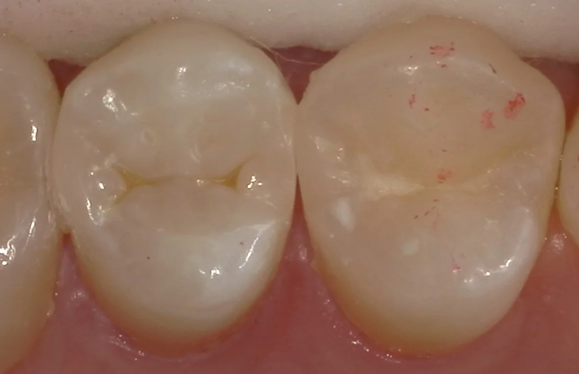 歯科医師の方の虫歯治療。|坂寄歯科医院(取手市藤代) - 画像4