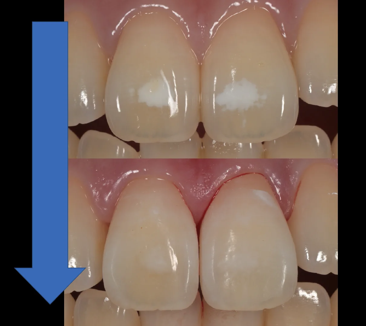 ICON治療。|坂寄歯科医院(取手市藤代) - 画像7