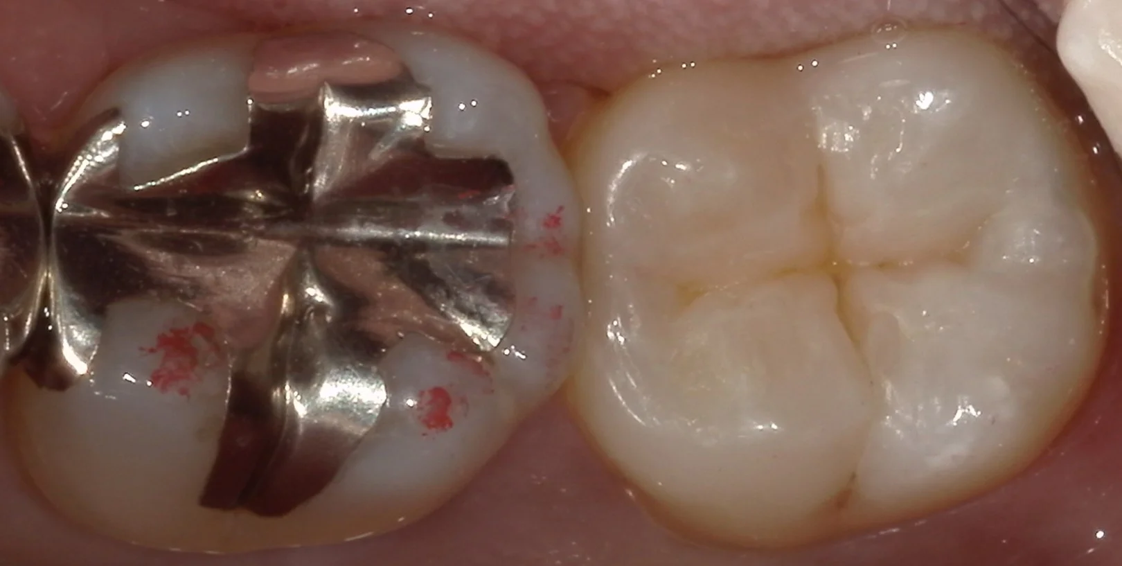 小さな虫歯ほど自費がおすすめ。｜坂寄歯科医院（取手市藤代） - 画像4