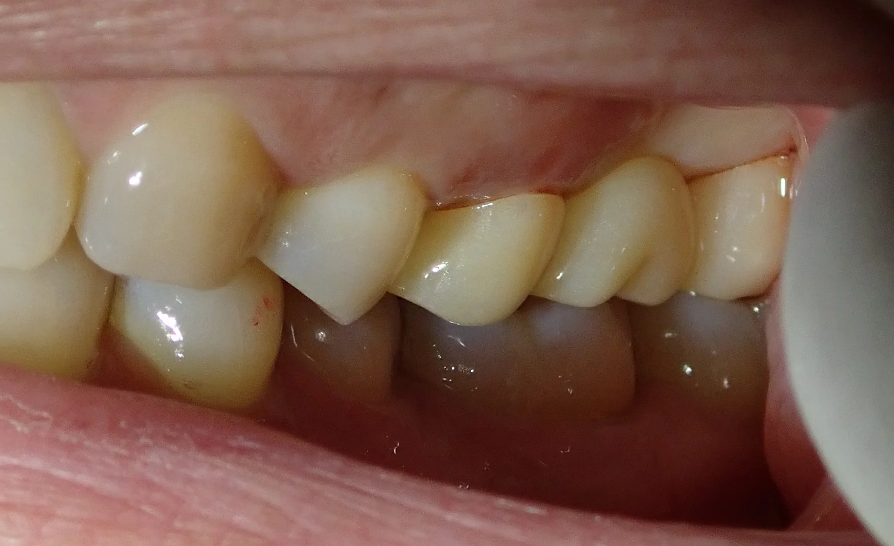 奥歯のセラミックブリッジ|坂寄歯科医院(取手市藤代) - 画像5