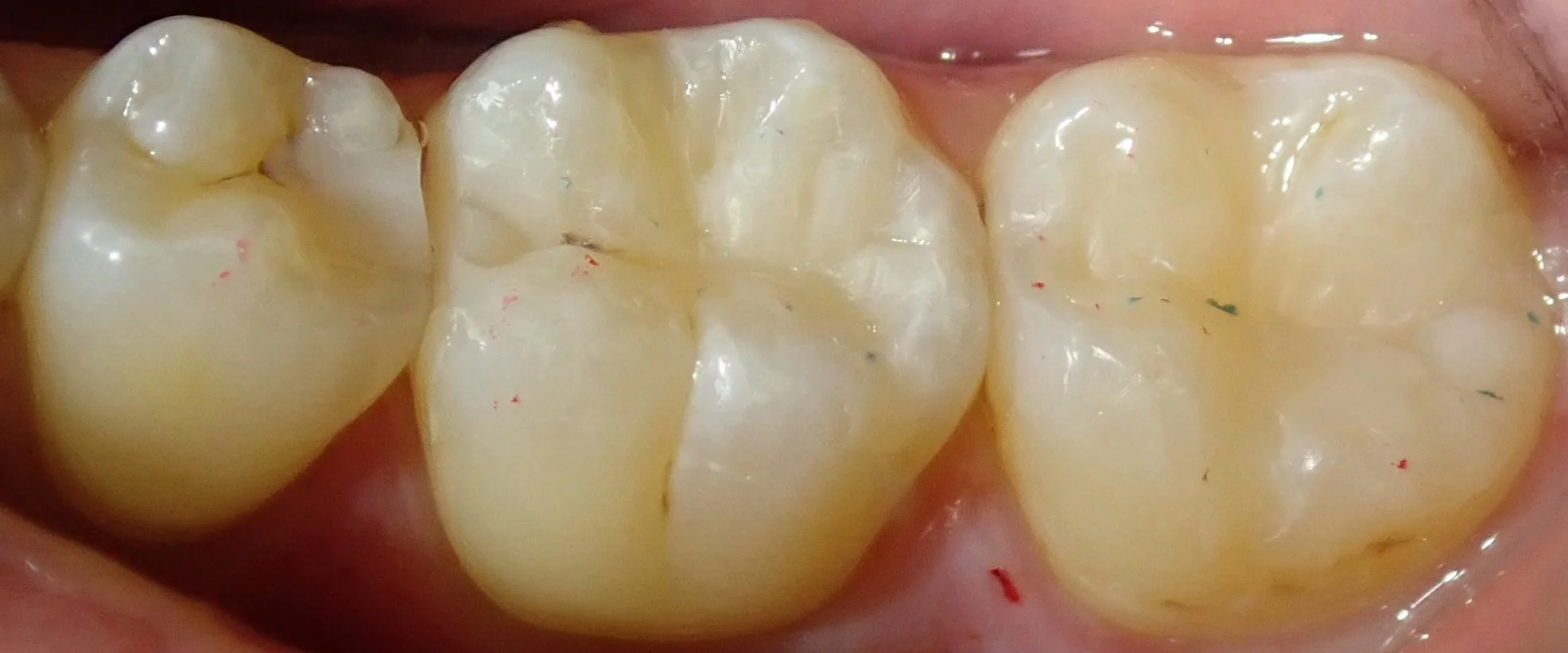 左下奥2本の白い詰め物|坂寄歯科医院(取手市藤代) - 画像3