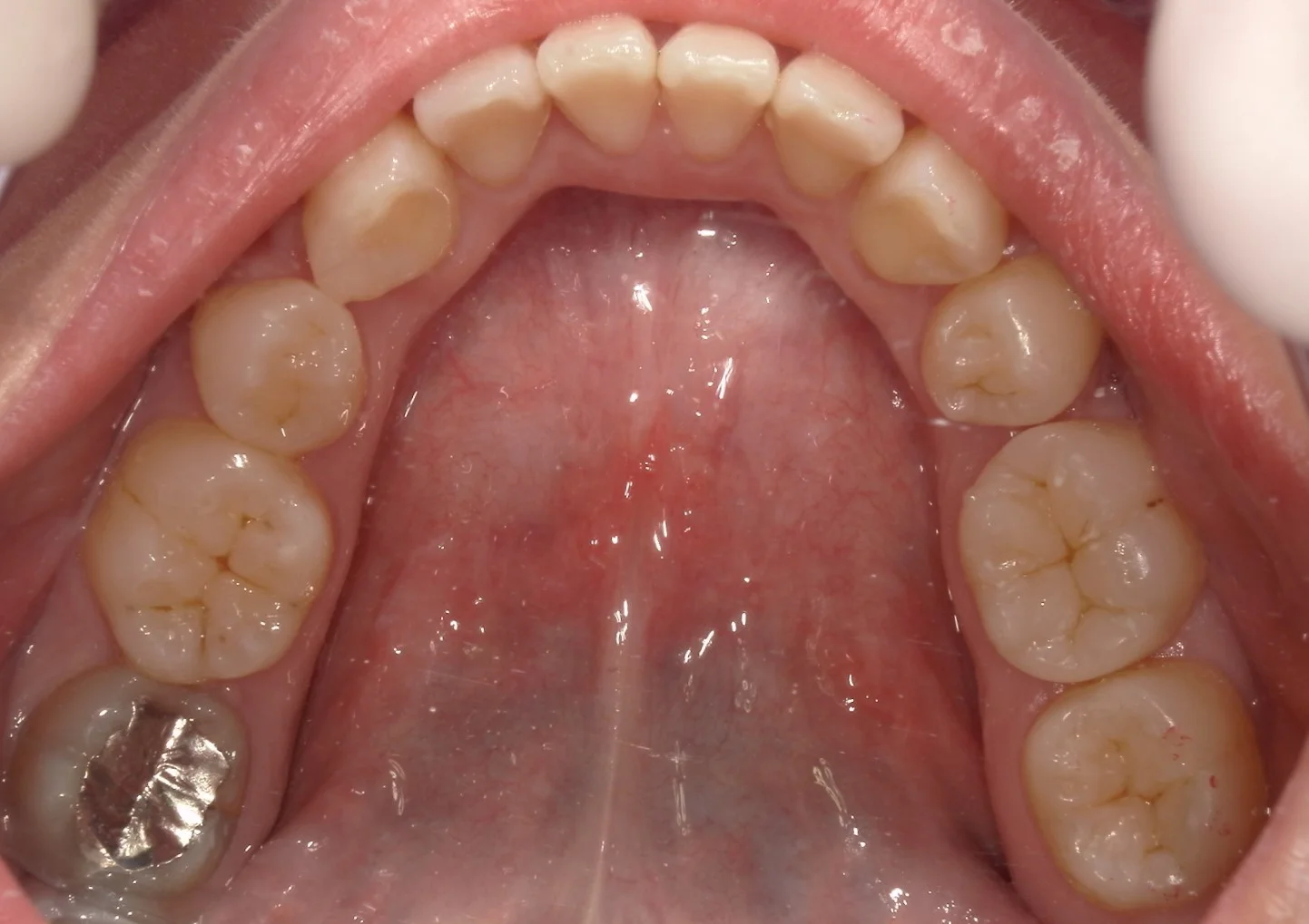 全体的に自費の白い詰め物で治したケース。｜坂寄歯科医院（取手市藤代） - 画像2