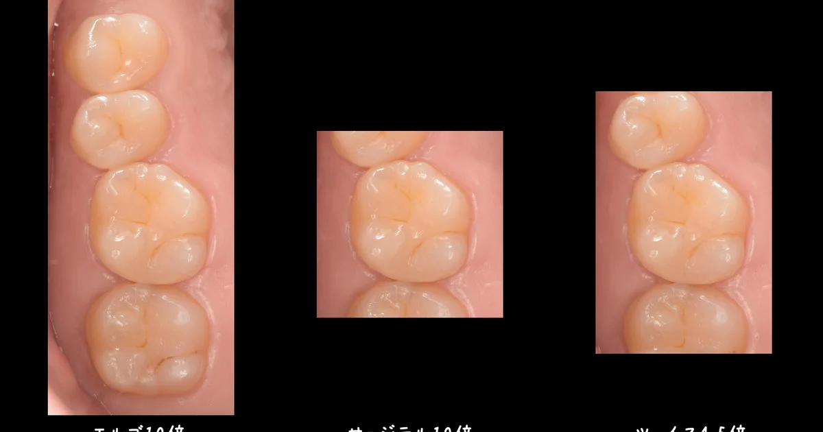 エルゴTTLルーペを装着した歯科医師が診療に集中している様子