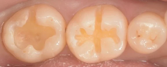 見た目が気になるレジンを天然の歯の様に。|坂寄歯科医院(取手市藤代) - 画像2