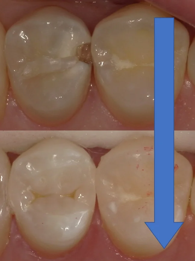 歯科医師の方の虫歯治療。|坂寄歯科医院(取手市藤代) - 画像5