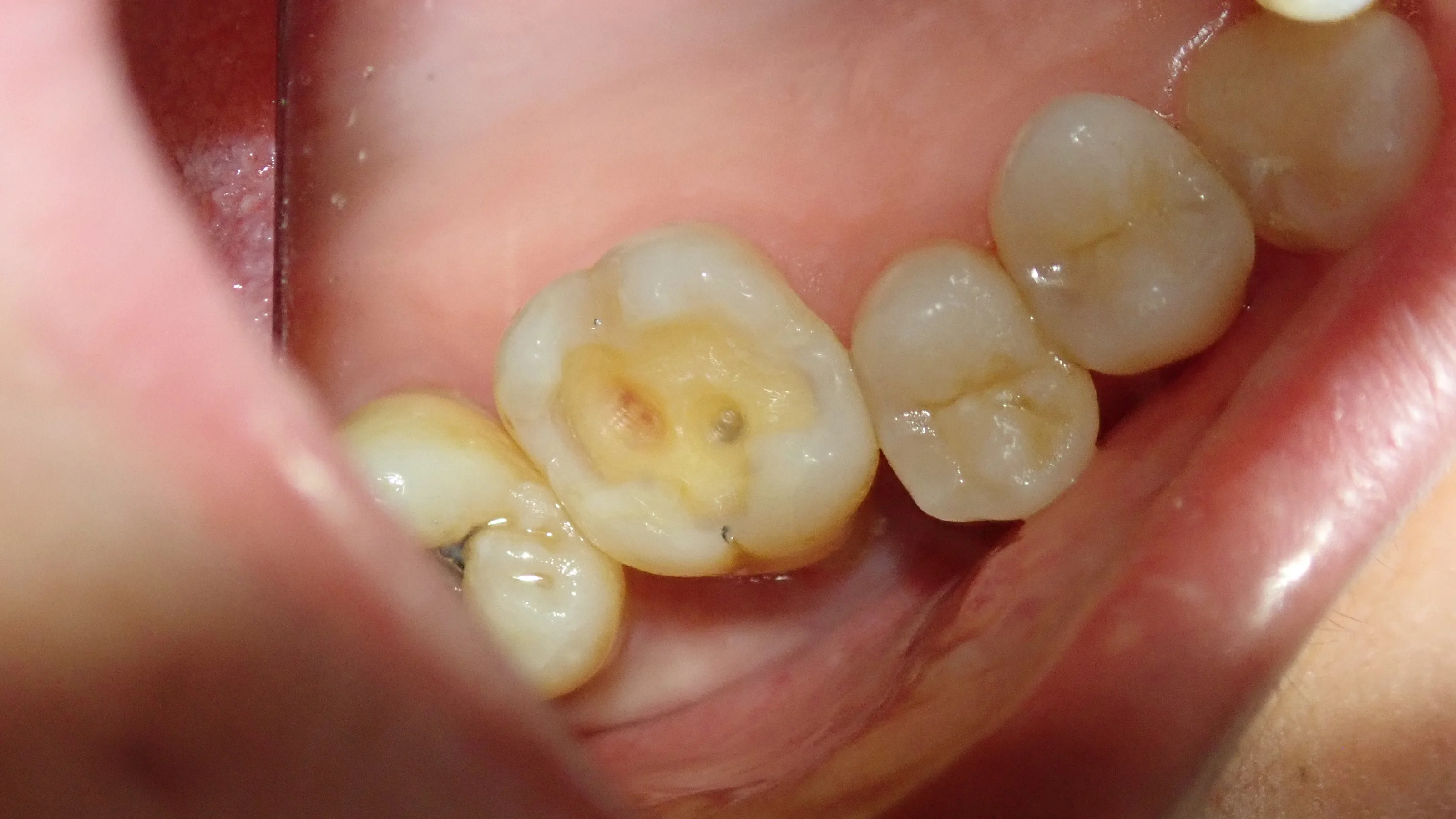 右上6ダイレクトボンディング|坂寄歯科医院(取手市藤代) - 画像3