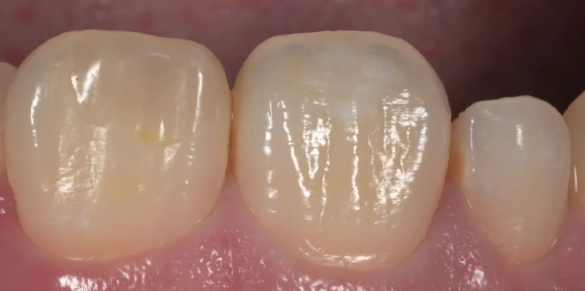 ICON治療にてホワイトスポットを改善。|坂寄歯科医院(取手市藤代)