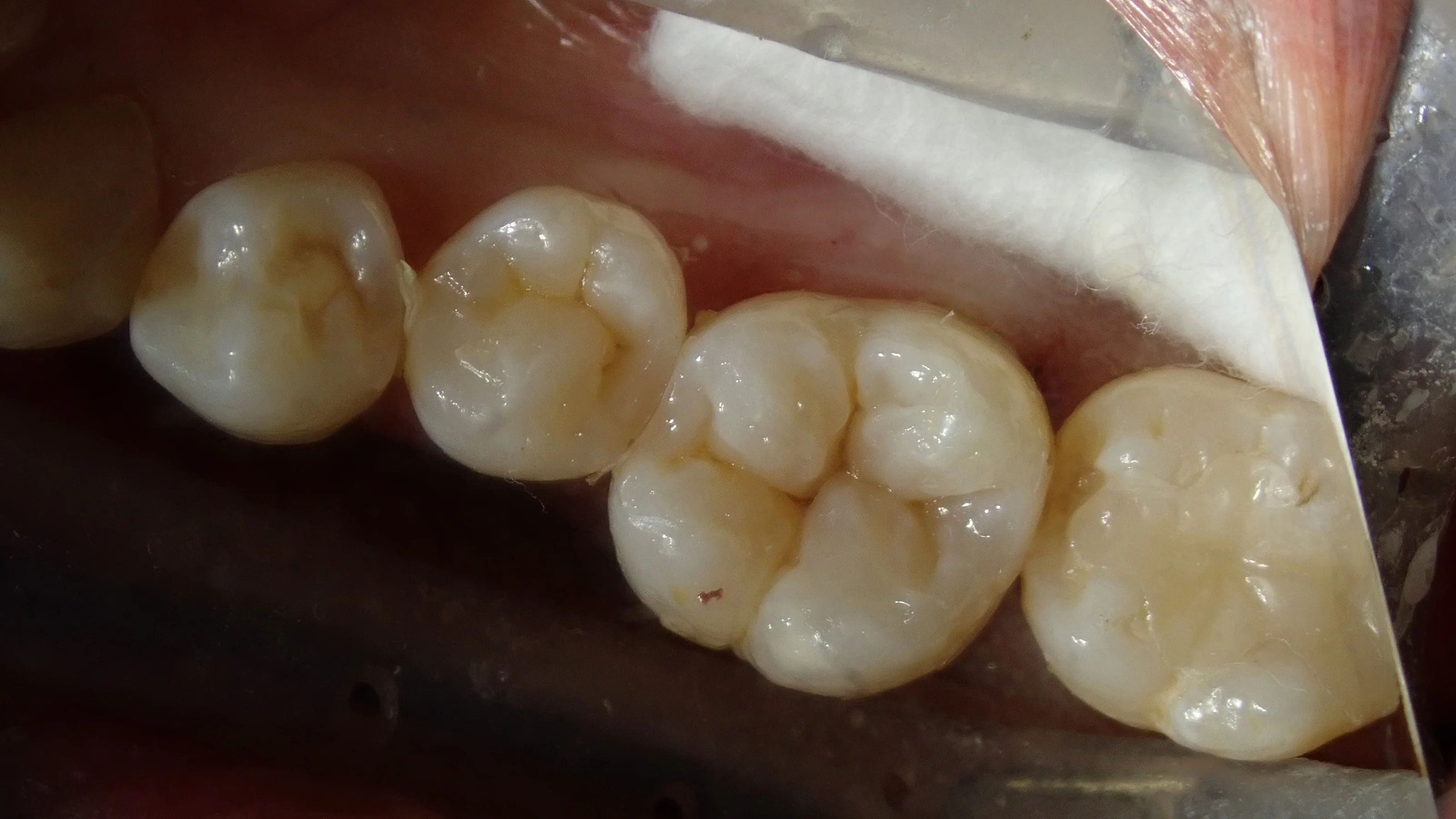 ダイレクトボンディング⑦|坂寄歯科医院(取手市藤代) - 画像5