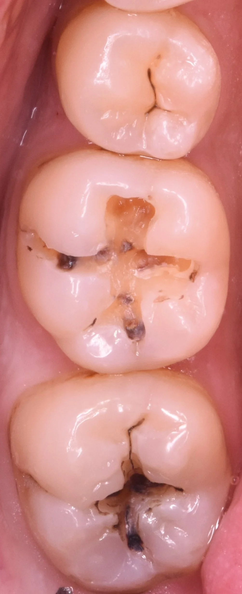 奥歯2本の治療を1日で。|坂寄歯科医院(取手市藤代) - 画像2