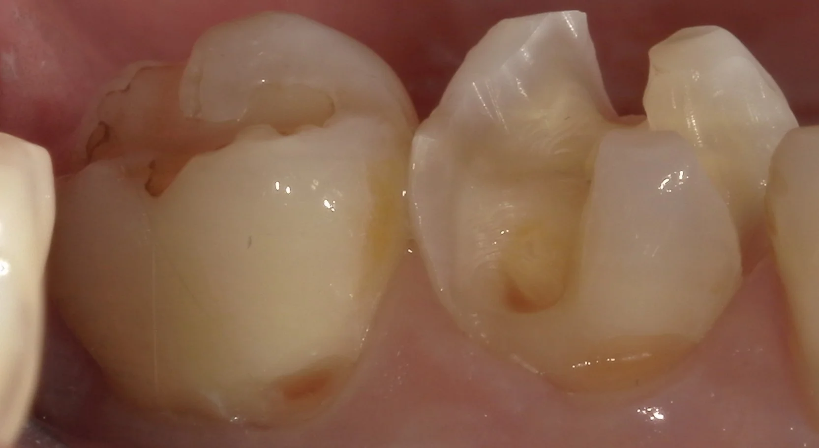 歯の側面も同時に治療したケース。|坂寄歯科医院(取手市藤代) - 画像4