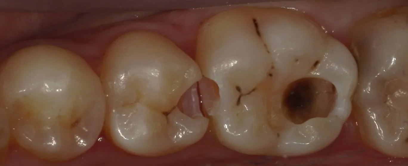 歯科医師の方をダイレクトボンディングにて治療。｜坂寄歯科医院（取手市藤代） - 画像3