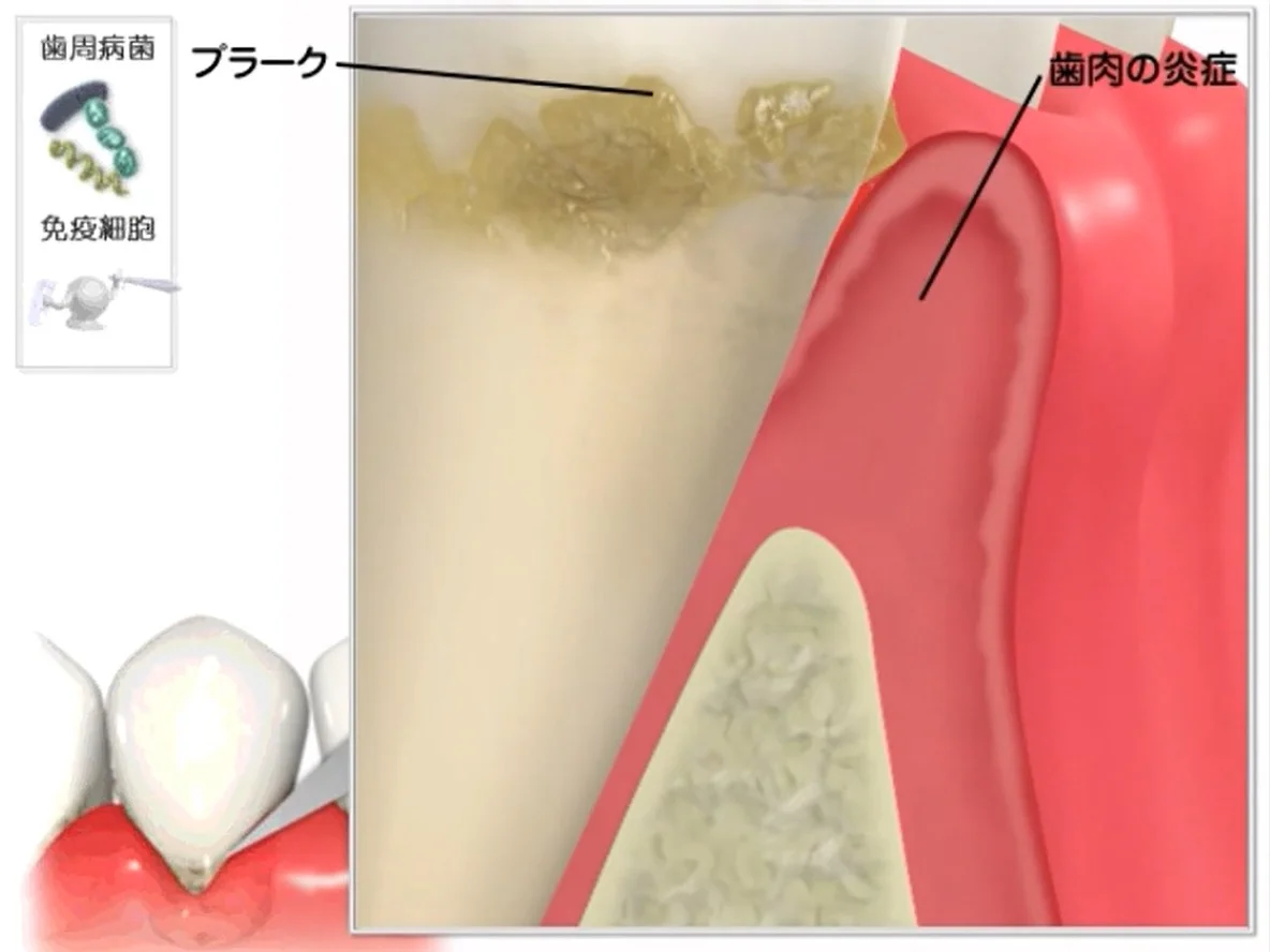 Q&A~歯周病ってなに?①~|坂寄歯科医院(取手市藤代) - 画像4