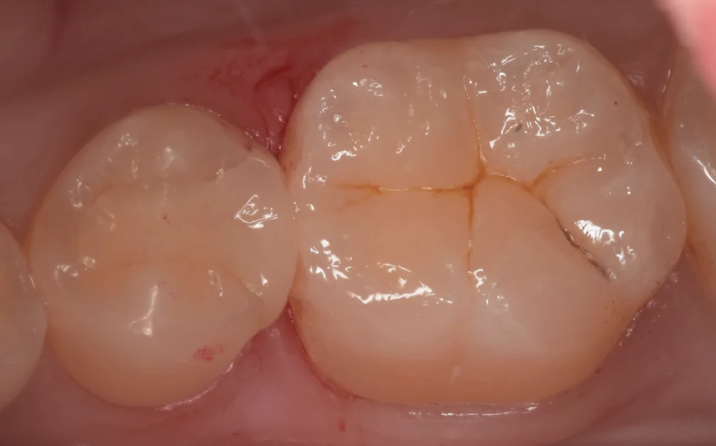 歯科医師の歯を1日で本物の歯のように。|坂寄歯科医院(取手市藤代) - 画像3