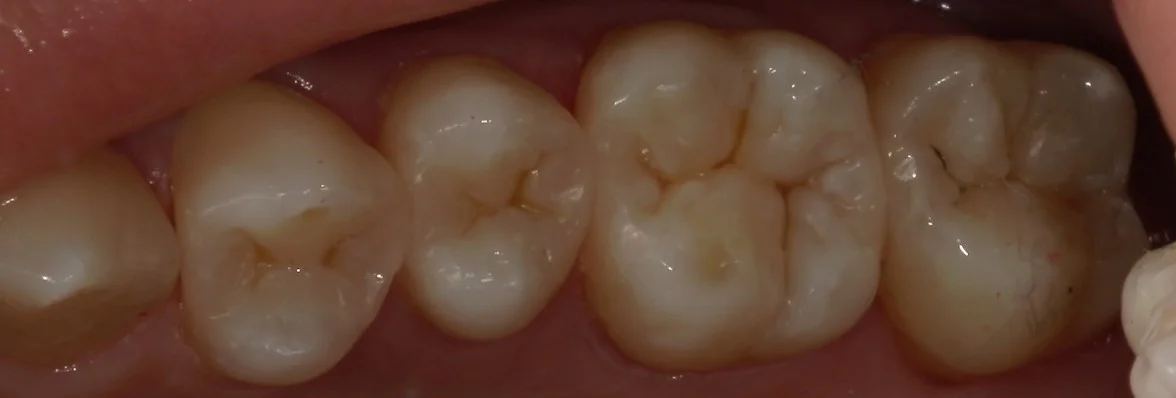 全体的に金属を白くしたいという方の治療｜坂寄歯科医院（取手市藤代） - 画像4