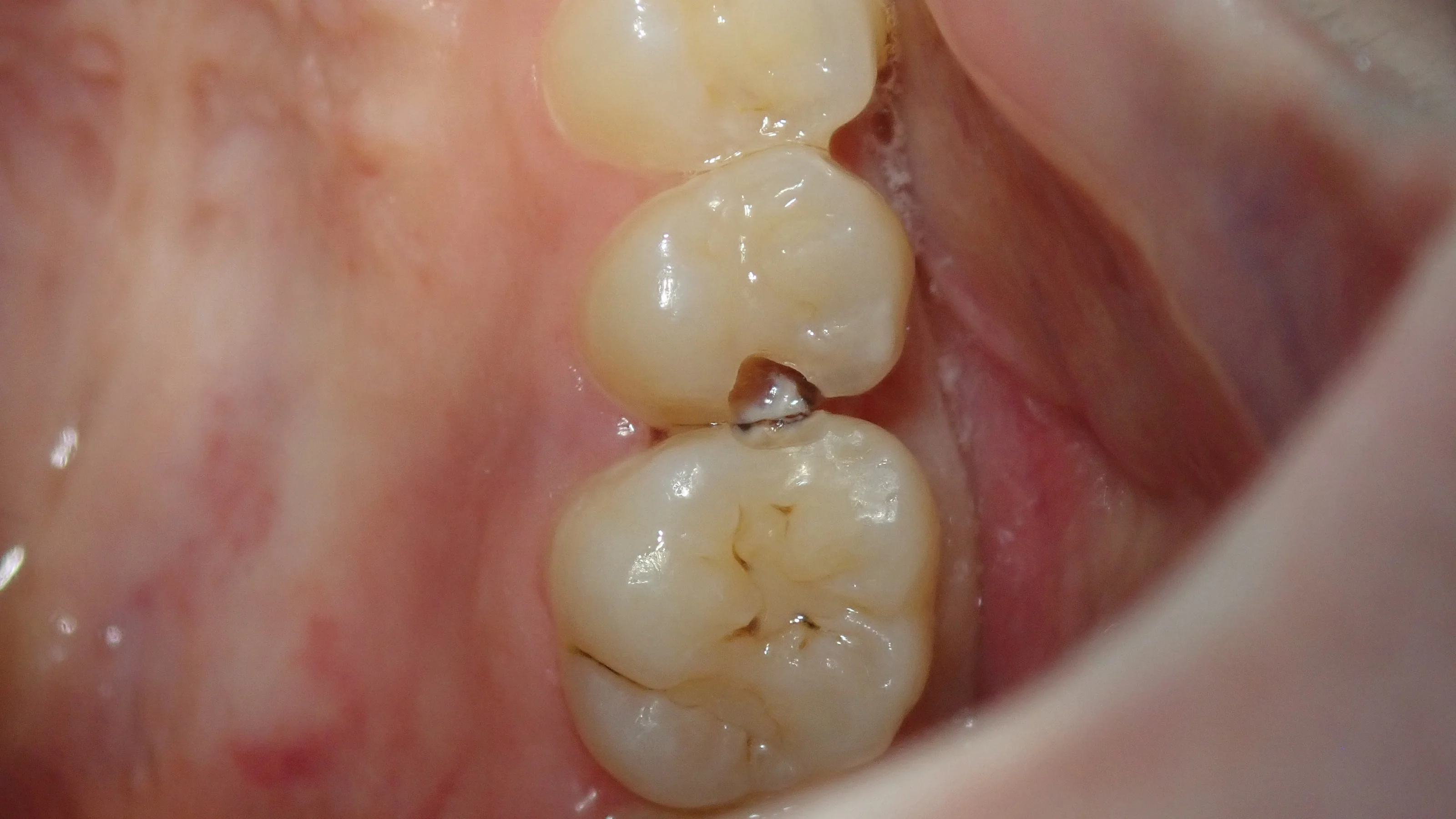 コンポジットレジン②｜坂寄歯科医院（取手市藤代） - 画像2