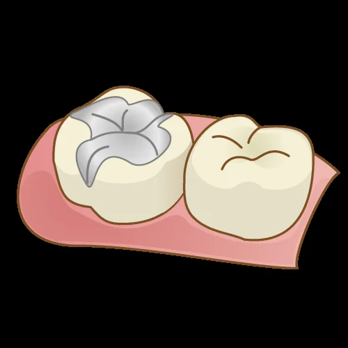 歯を可及的に温存したブリッジ|坂寄歯科医院(取手市藤代) - 画像2