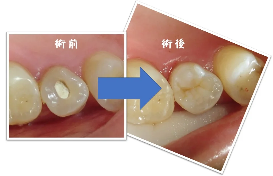 上顎小臼歯ダイレクトボンディング|坂寄歯科医院(取手市藤代) - 画像4