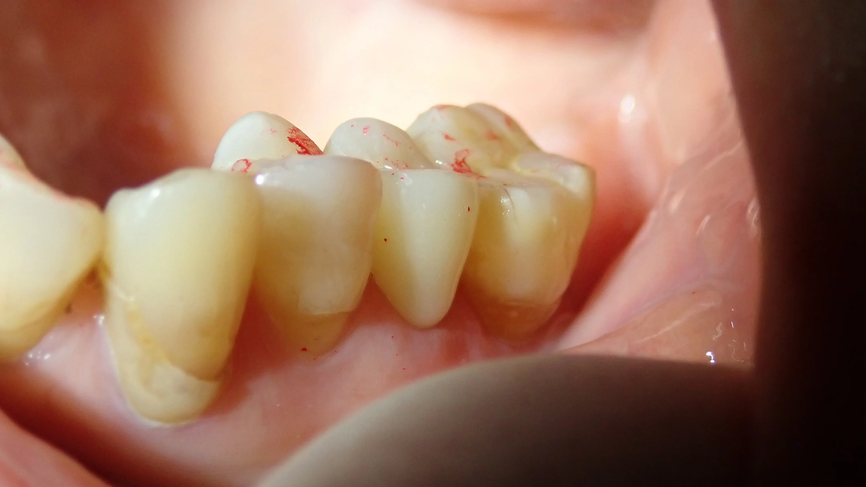 口腔内スキャナーでのセラミック｜坂寄歯科医院（取手市藤代） - 画像4