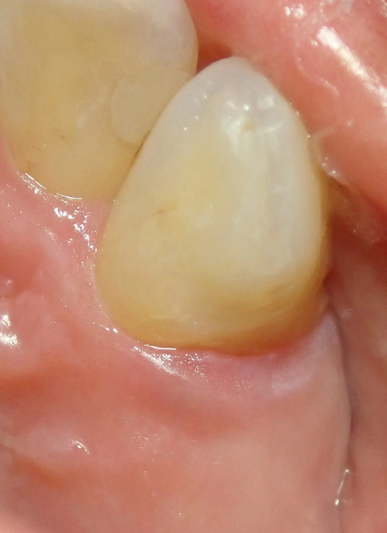 右上犬歯の白い詰め物｜坂寄歯科医院（取手市藤代） - 画像6