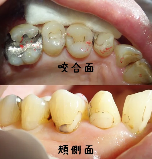 3本連続ダイレクトボンディング|坂寄歯科医院(取手市藤代)