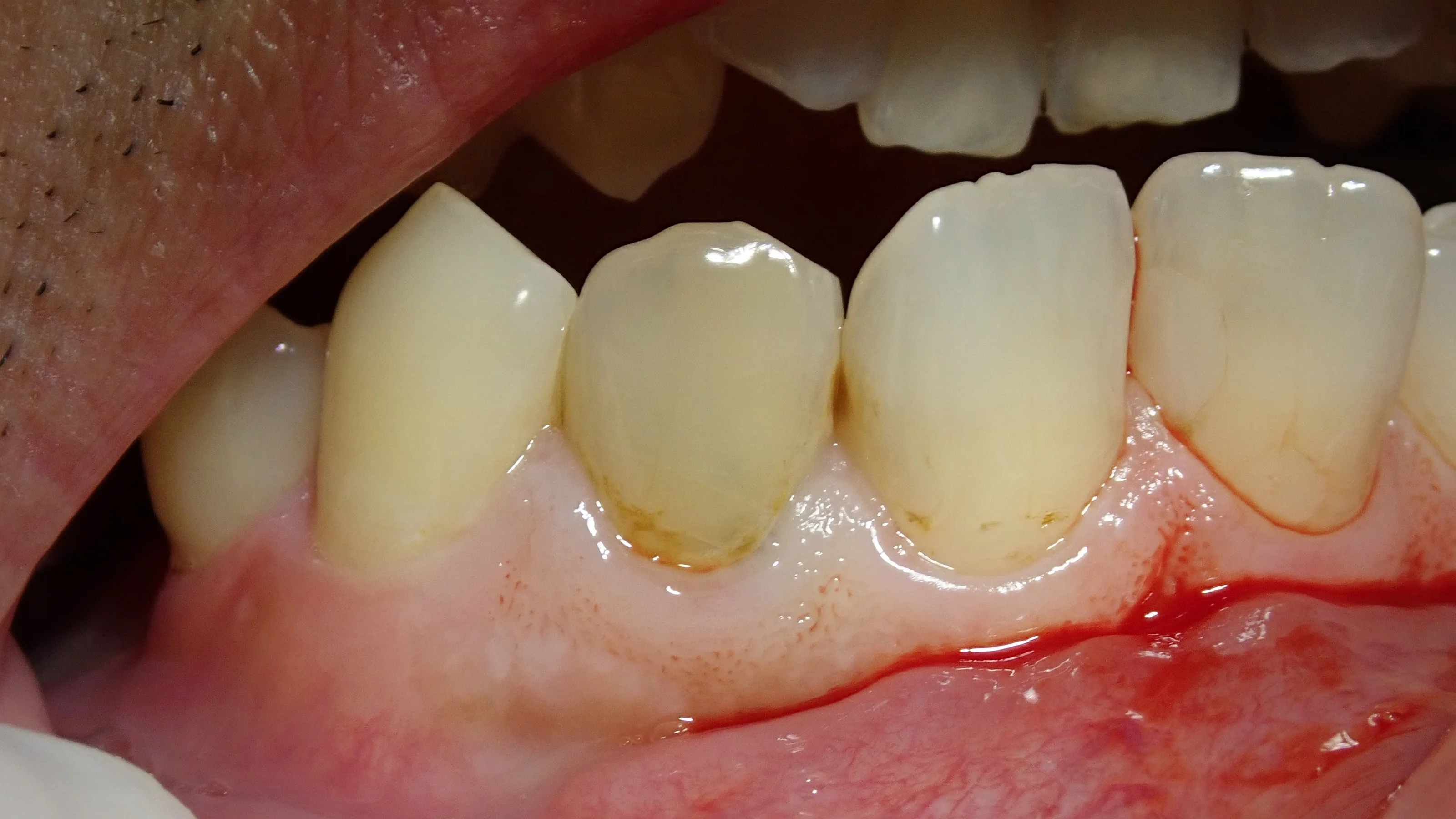 前歯のダイレクトベニア|坂寄歯科医院(取手市藤代) - 画像2