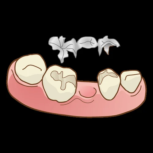 歯を可及的に温存したブリッジ|坂寄歯科医院(取手市藤代) - 画像3