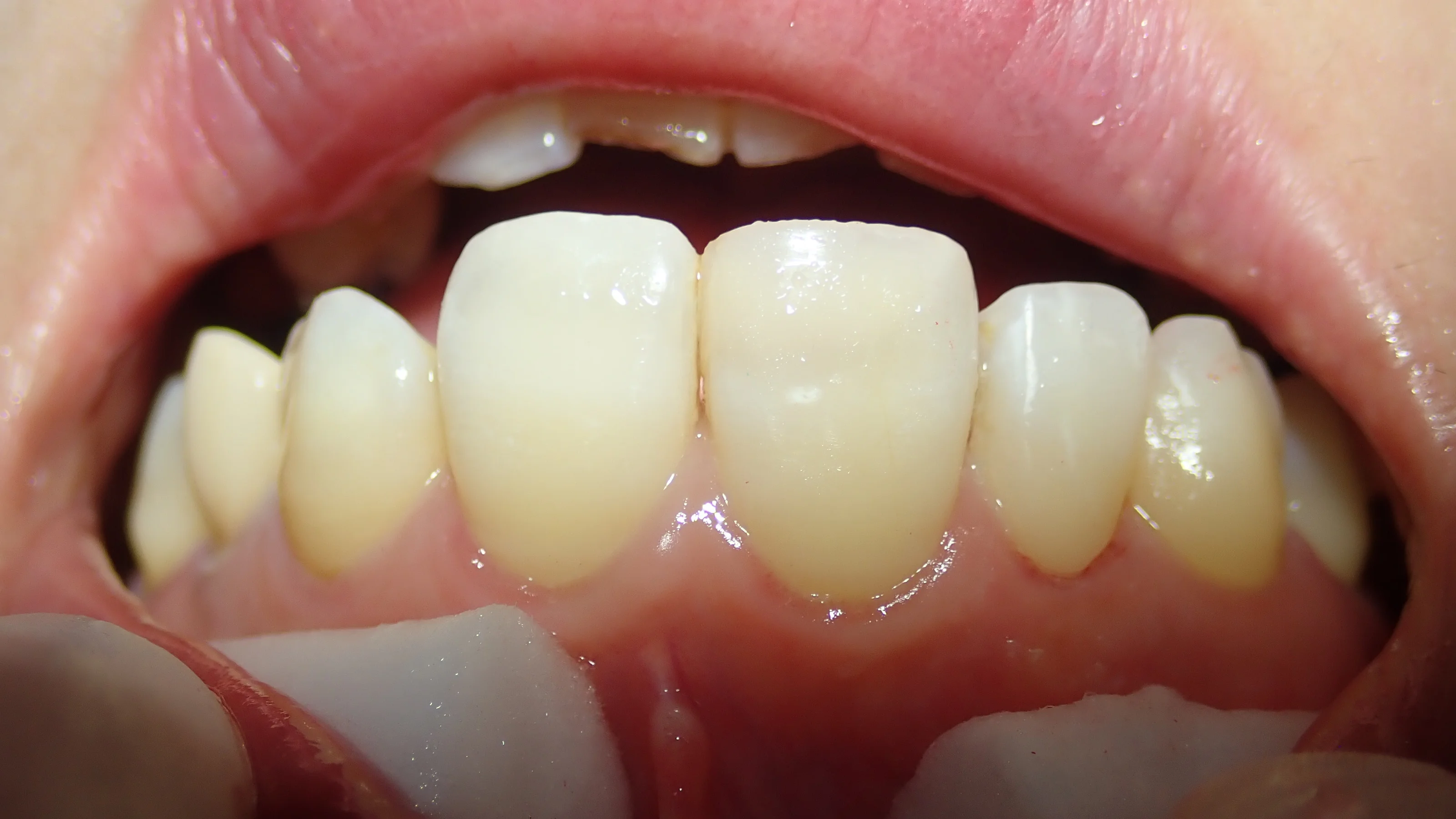 前歯ダイレクトボンディング②|坂寄歯科医院(取手市藤代) - 画像2