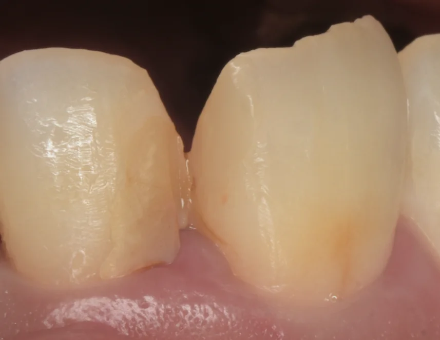 不適合なレジンを再治療。|坂寄歯科医院(取手市藤代)