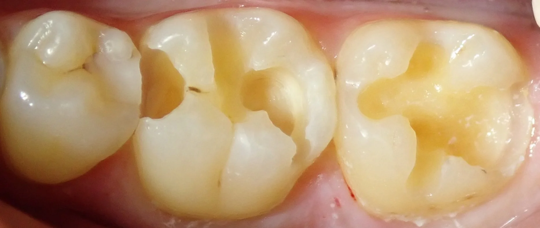 左下奥2本の白い詰め物|坂寄歯科医院(取手市藤代) - 画像2