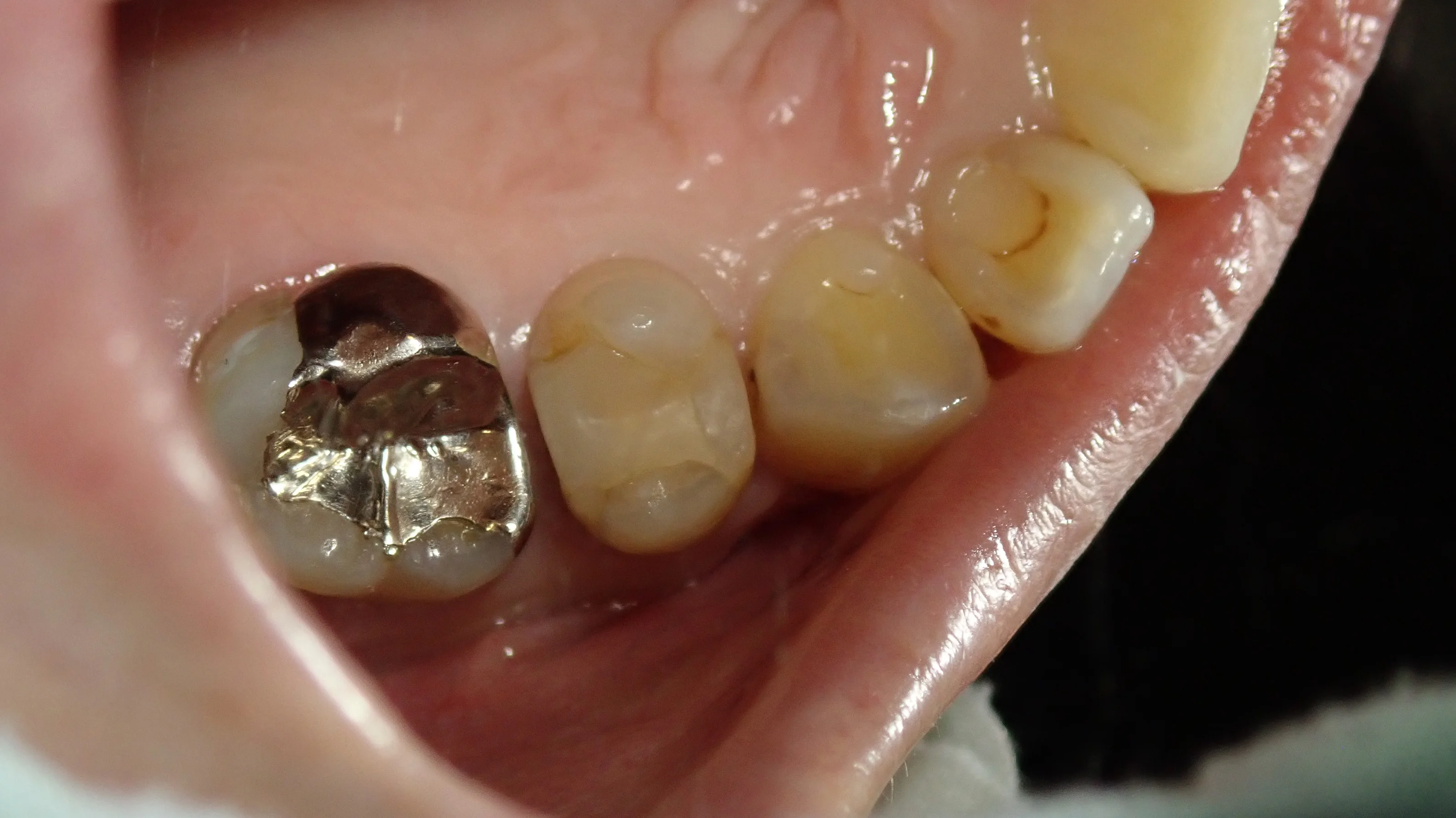 犬歯と奥歯の白い詰め物｜坂寄歯科医院（取手市藤代）