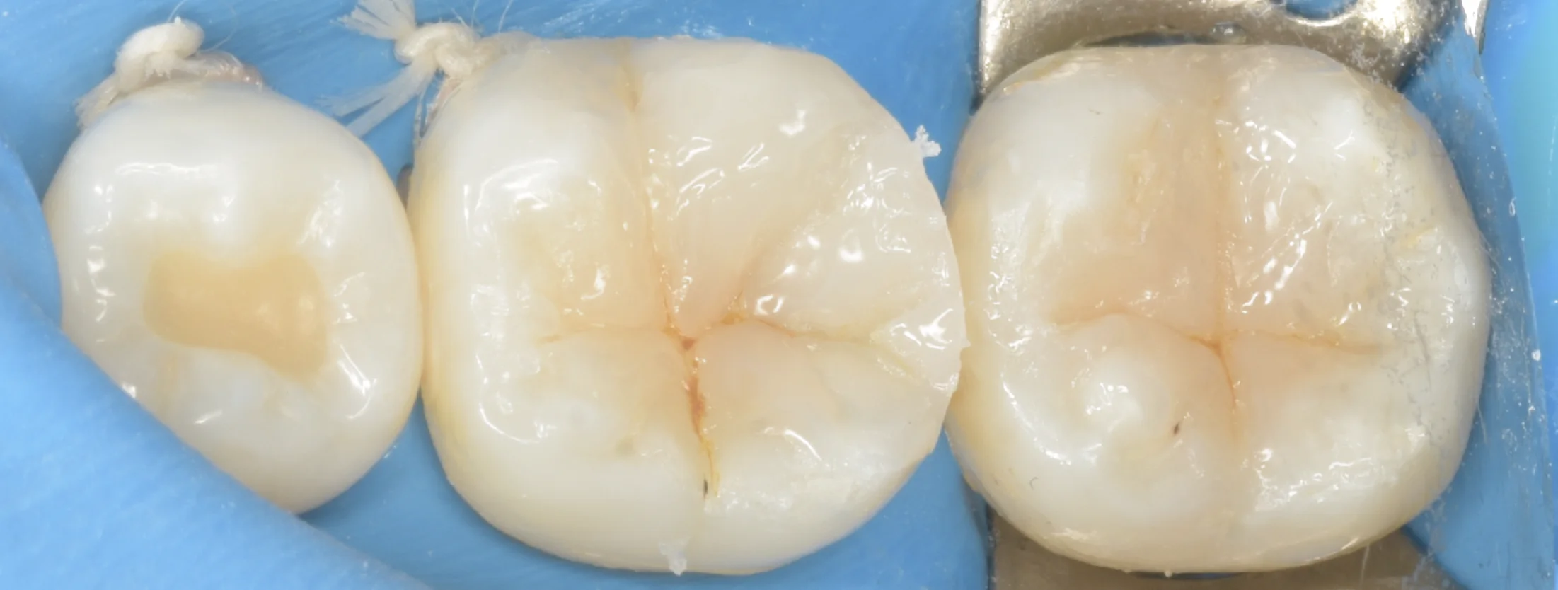 歯科医師の方のCAD/CAMインレーを治療。|坂寄歯科医院(取手市藤代) - 画像7