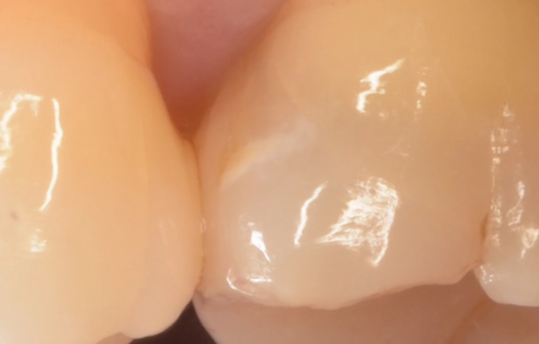 左上第1大臼歯(#26)のダイレクトボンディング修復。歯肉縁下約2mmからマージンを立ち上げ、歯頸部マージンにGiomerを選択。術後2年経過時の口腔内写真で、歯肉の発赤・腫脹およびCR表面のプラーク付着は明らかな所見なし。