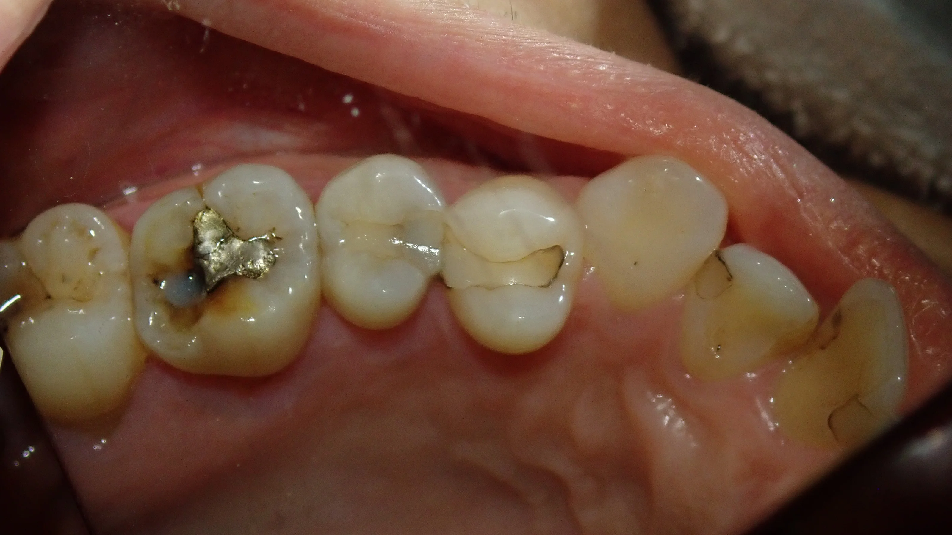 白い部分的な詰め物｜坂寄歯科医院（取手市藤代）