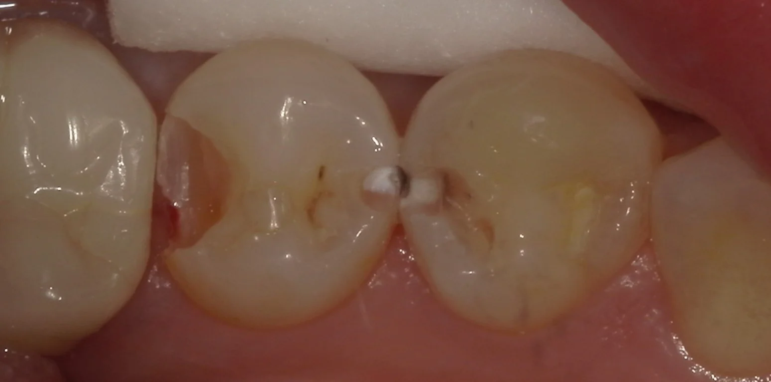 右下奥歯を纏めて治療。遠方からの通院。｜坂寄歯科医院（取手市藤代） - 画像2