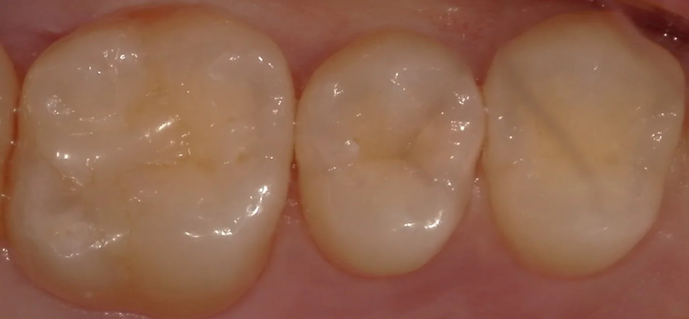 遠方から白い詰め物での治療を求めて・・・｜坂寄歯科医院（取手市藤代）