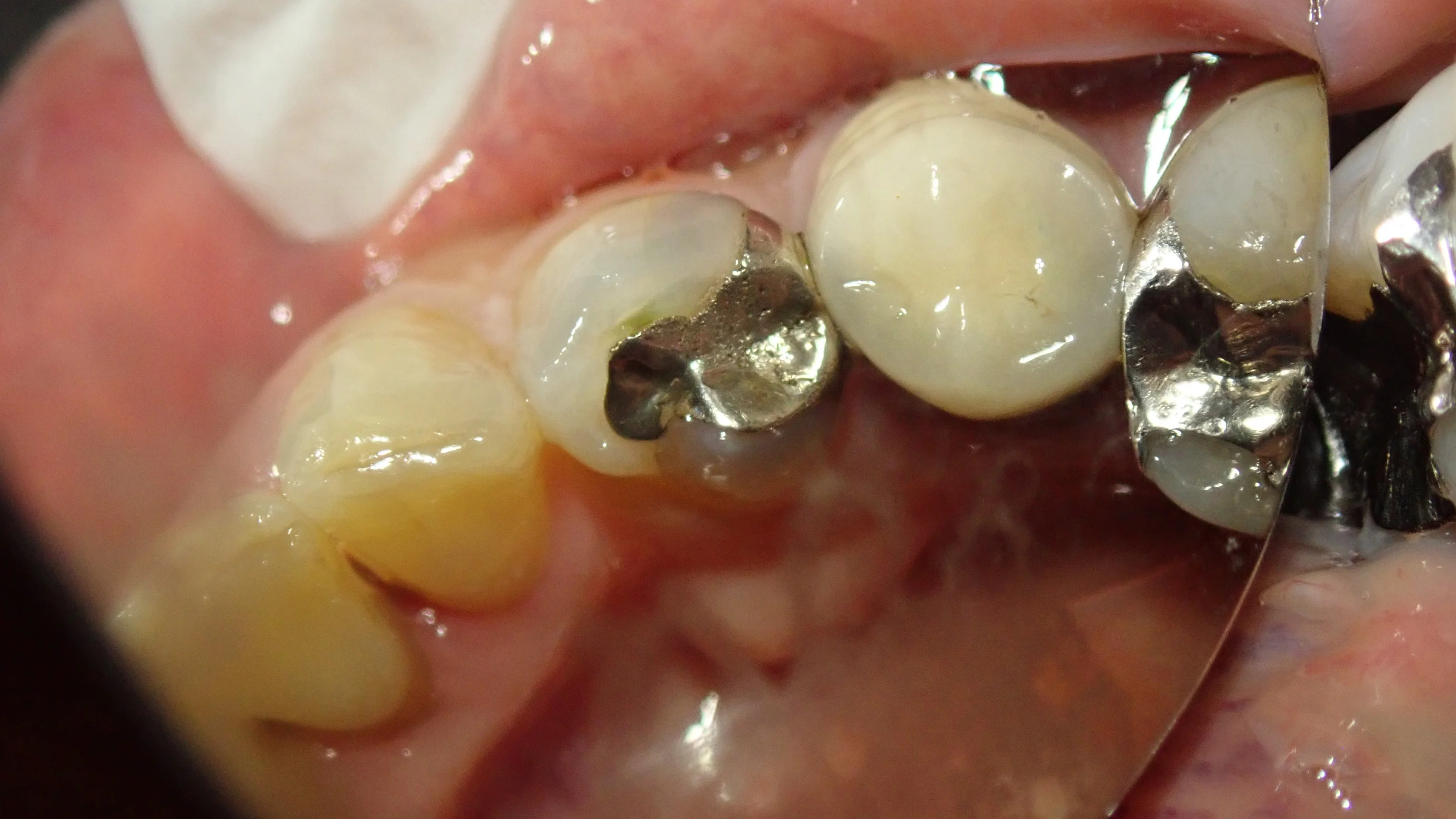 ダイレクトボンディング｜坂寄歯科医院（取手市藤代）