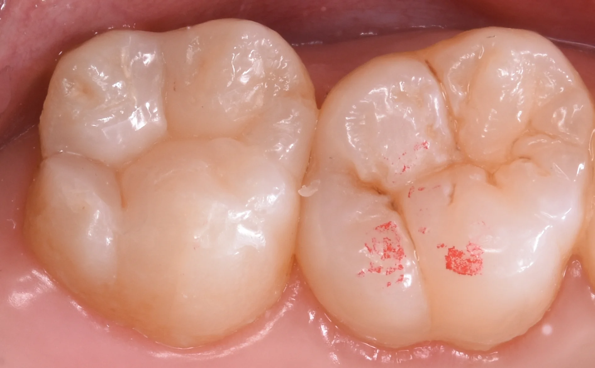 上の奥歯を金属から白い詰め物に。｜坂寄歯科医院（取手市藤代） - 画像4