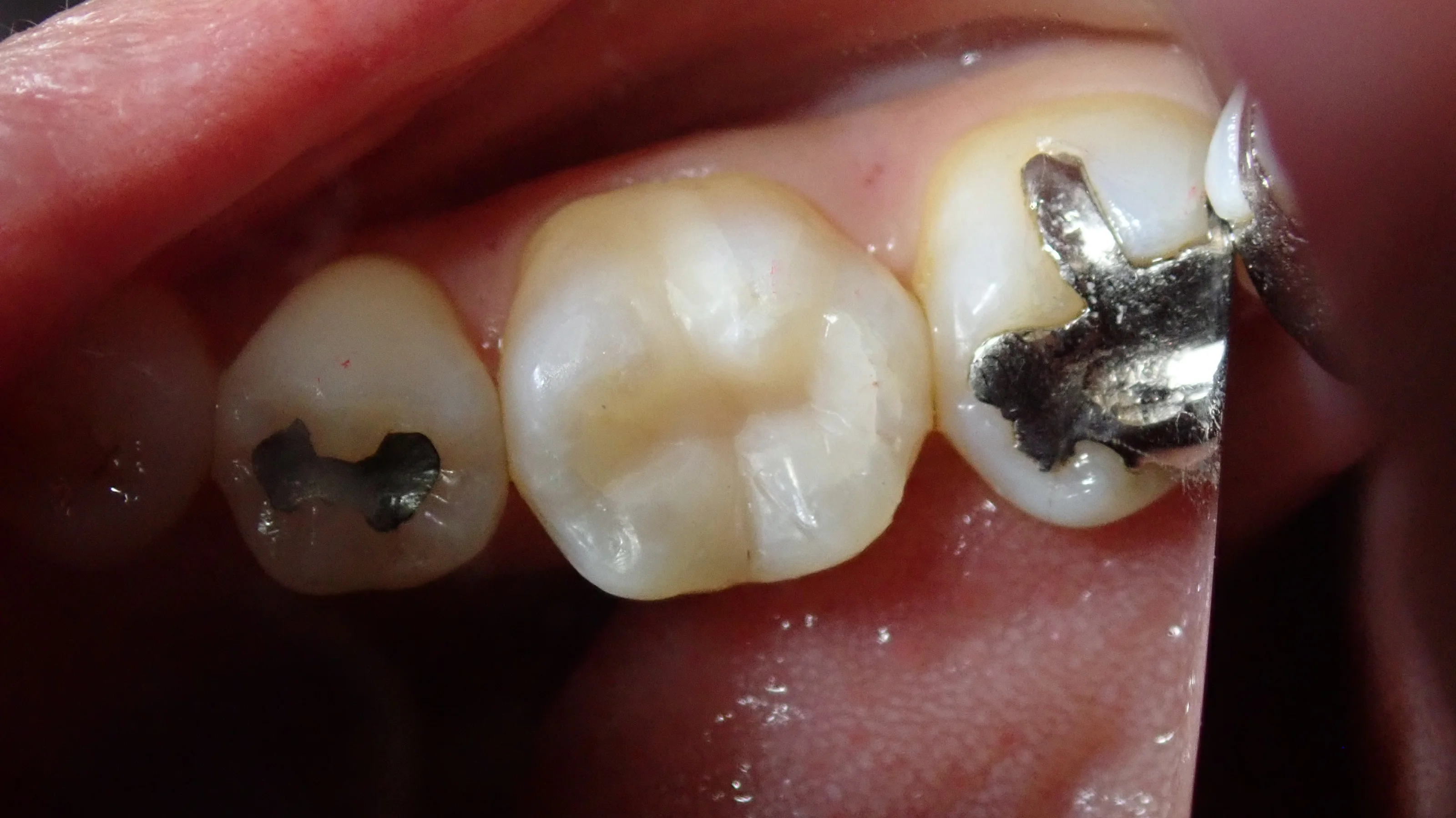 コンポジットレジン|坂寄歯科医院(取手市藤代) - 画像4